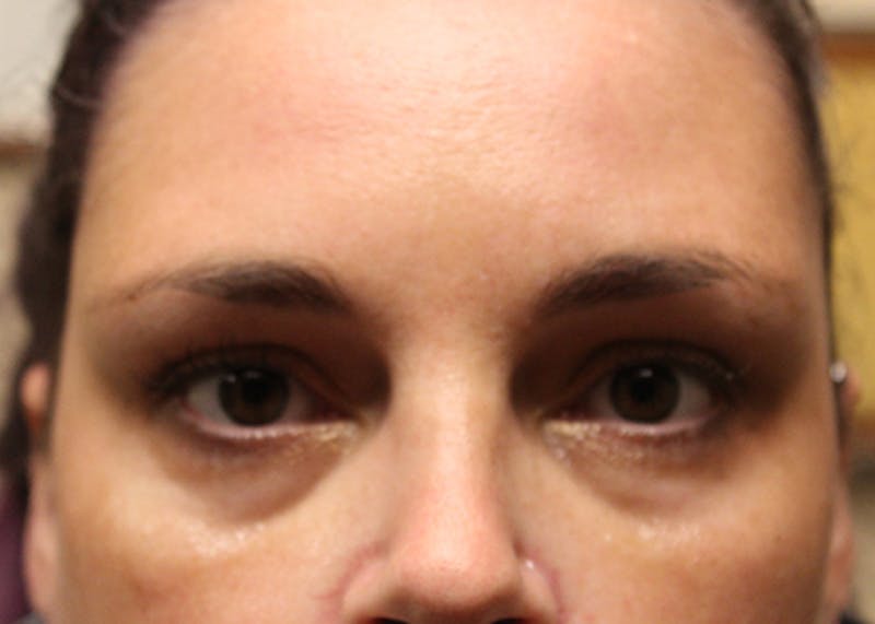 Injectables Before & After Gallery - Patient 174146492 - Image 1