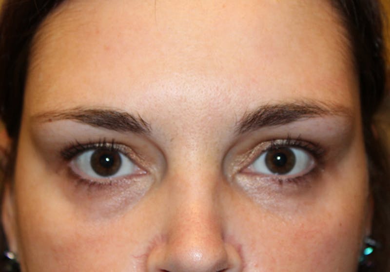 Injectables Before & After Gallery - Patient 174146492 - Image 2