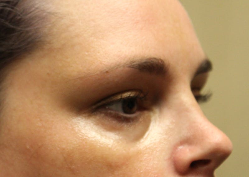 Injectables Before & After Gallery - Patient 174146492 - Image 3