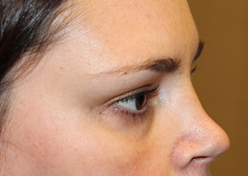 Injectables Before & After Gallery - Patient 174146492 - Image 4