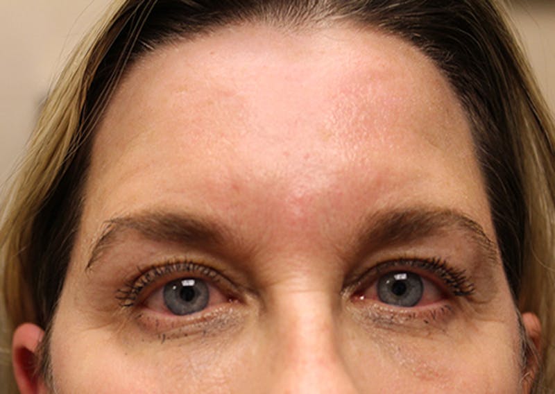 Injectables Before & After Gallery - Patient 174146497 - Image 1