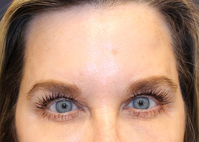 Injectables Before & After Gallery - Patient 174146497 - Image 2