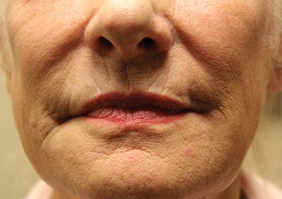 Injectables Before & After Gallery - Patient 174146501 - Image 1