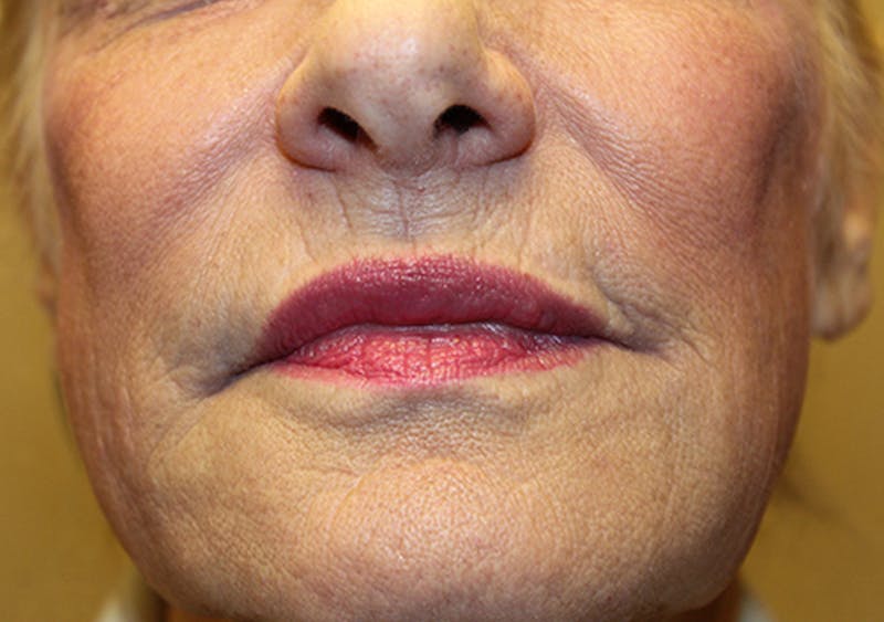 Injectables Before & After Gallery - Patient 174146501 - Image 2