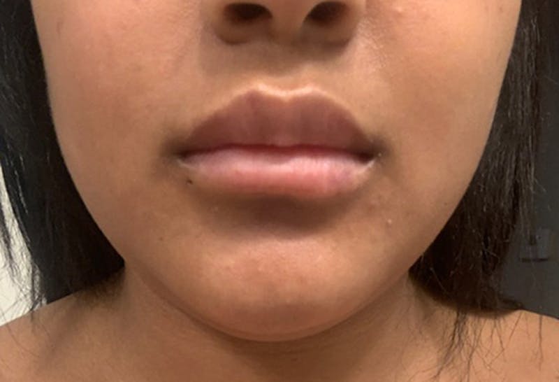 Injectables Before & After Gallery - Patient 174146506 - Image 4