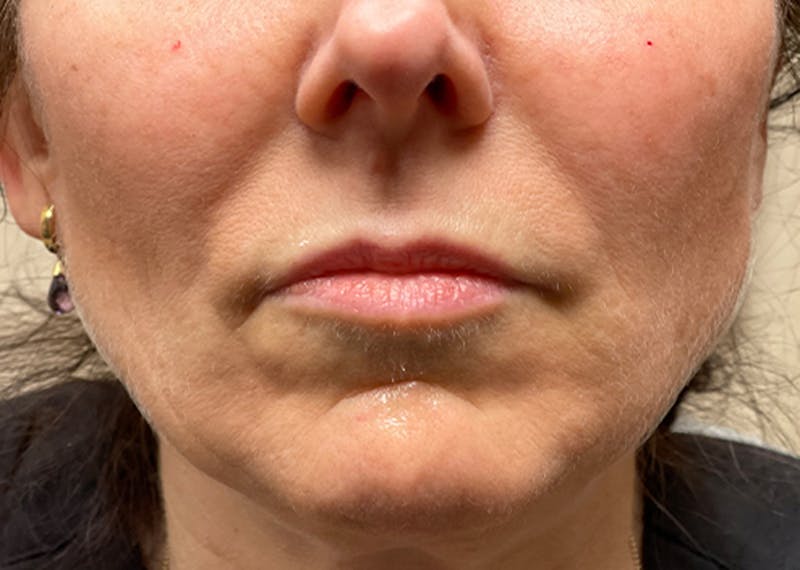 Injectables Before & After Gallery - Patient 174146510 - Image 1