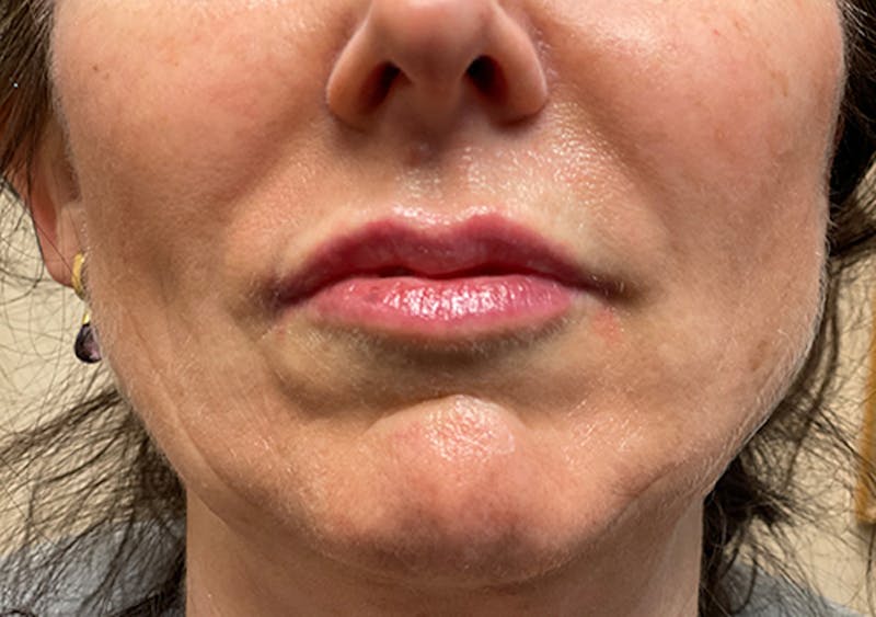 Injectables Before & After Gallery - Patient 174146510 - Image 2