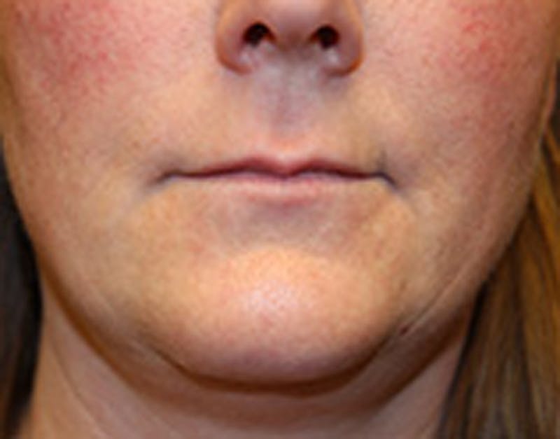 Injectables Before & After Gallery - Patient 174146519 - Image 1