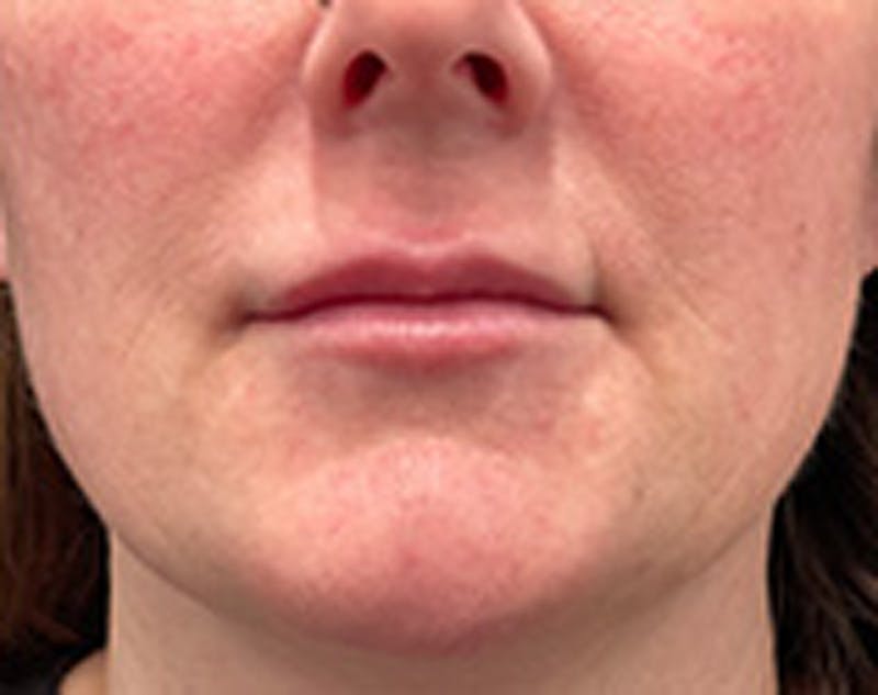 Injectables Before & After Gallery - Patient 174146519 - Image 2