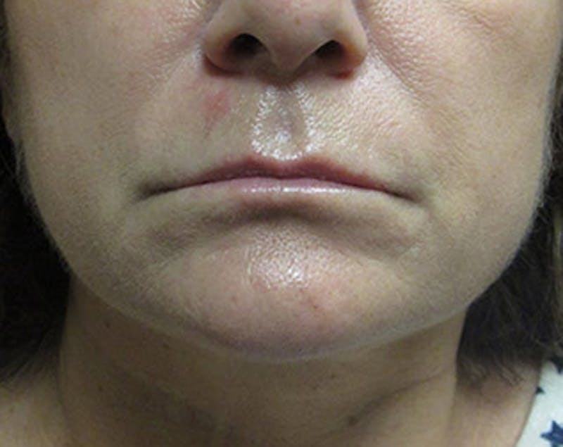 Injectables Before & After Gallery - Patient 174146522 - Image 1