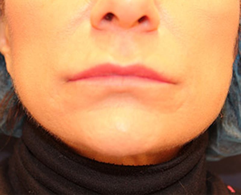Injectables Before & After Gallery - Patient 174146522 - Image 2