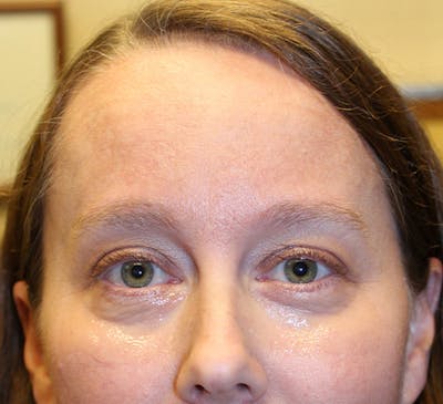 Injectables Before & After Gallery - Patient 174146528 - Image 1