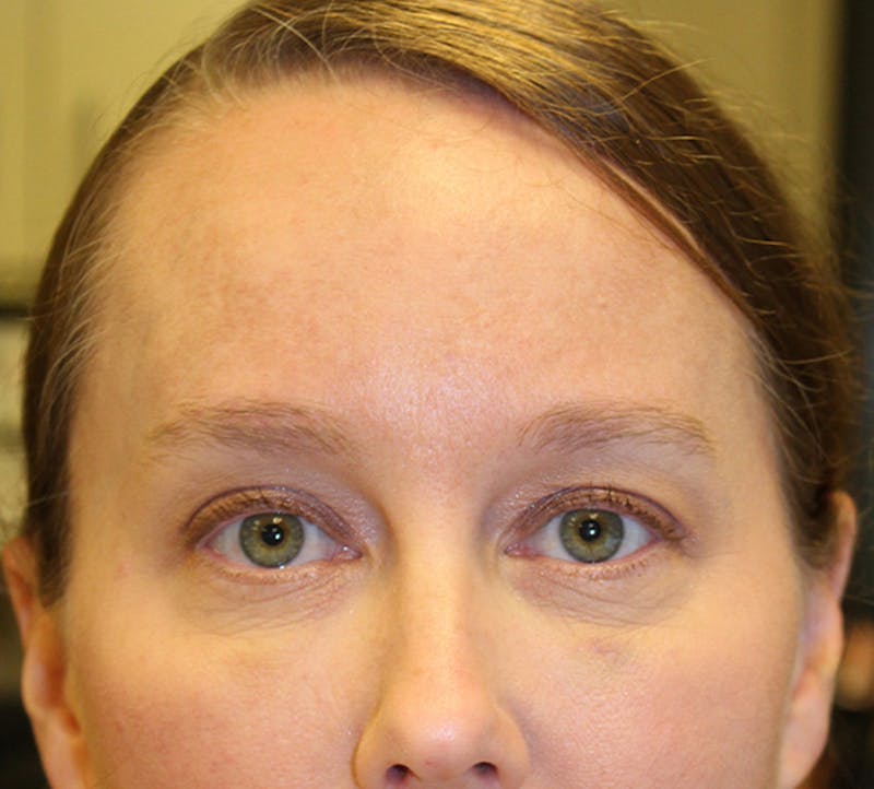 Injectables Before & After Gallery - Patient 174146528 - Image 2