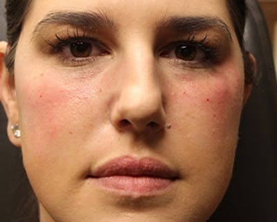 Injectables Before & After Gallery - Patient 174146555 - Image 1