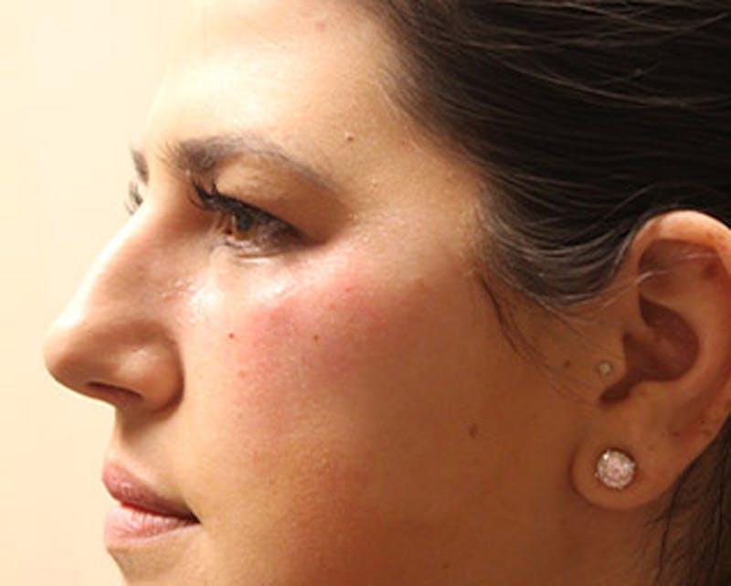 Injectables Before & After Gallery - Patient 174146555 - Image 5