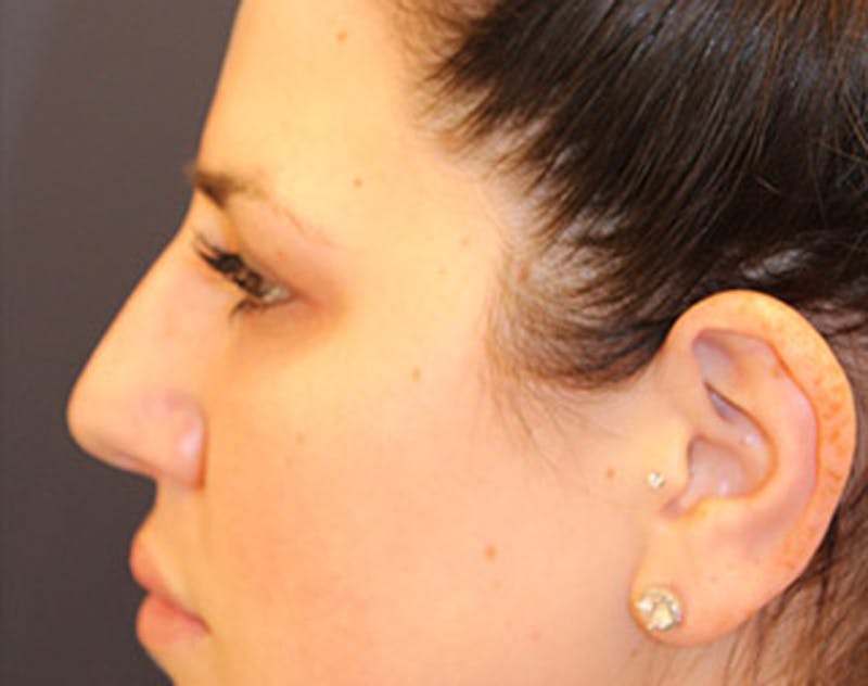 Injectables Before & After Gallery - Patient 174146555 - Image 6