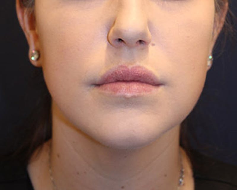 Injectables Before & After Gallery - Patient 174146555 - Image 7