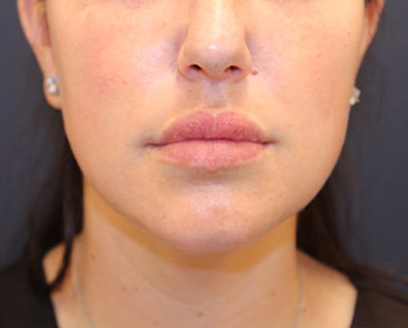 Injectables Before & After Gallery - Patient 174146555 - Image 8