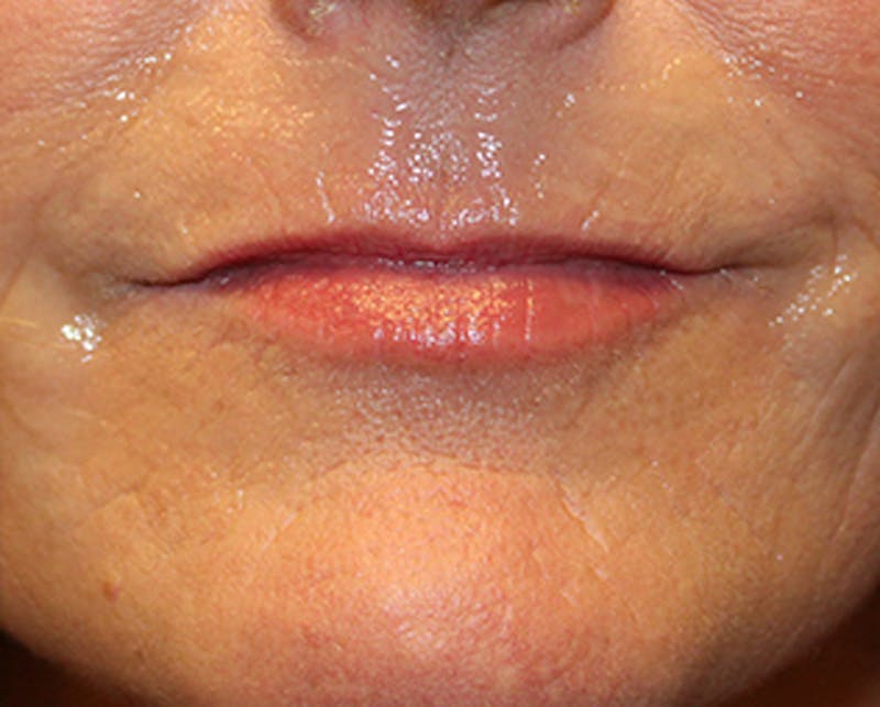 Injectables Before & After Gallery - Patient 174146558 - Image 1