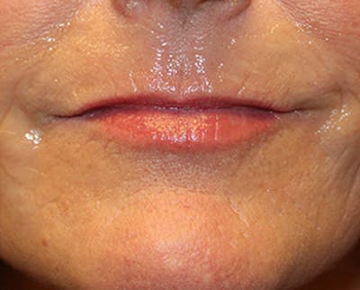 Injectables Before & After Gallery - Patient 174146558 - Image 1