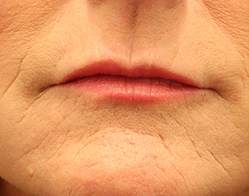 Injectables Before & After Gallery - Patient 174146558 - Image 2