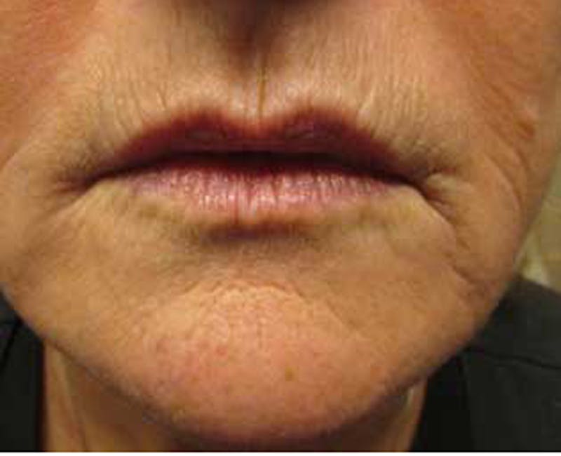 Injectables Before & After Gallery - Patient 174146563 - Image 1