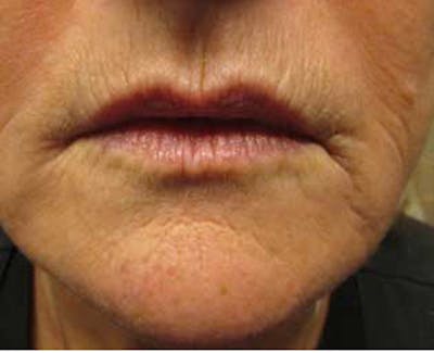 Injectables Before & After Gallery - Patient 174146563 - Image 1