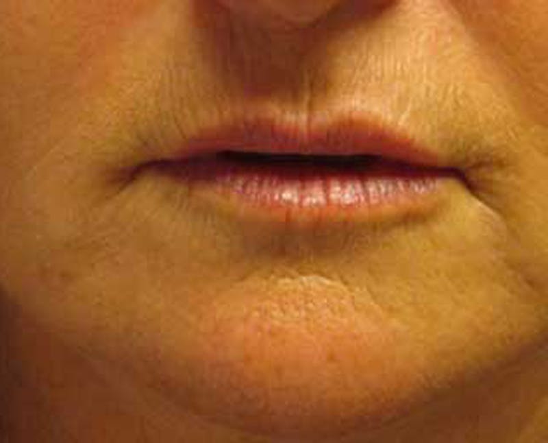 Injectables Before & After Gallery - Patient 174146563 - Image 2