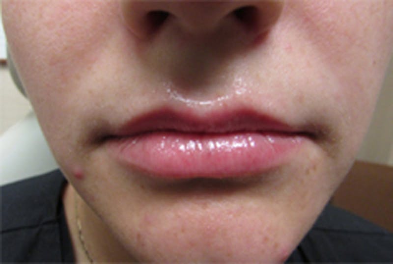 Injectables Before & After Gallery - Patient 174146565 - Image 1