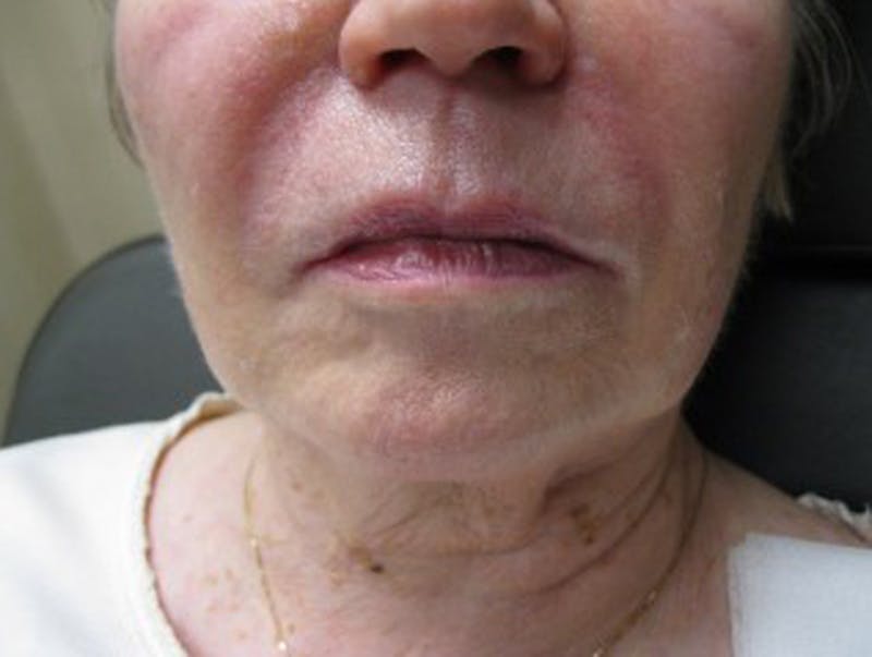 Injectables Before & After Gallery - Patient 174146567 - Image 1