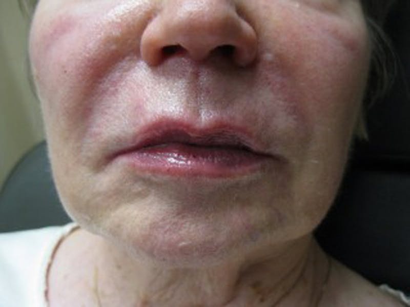 Injectables Before & After Gallery - Patient 174146567 - Image 2