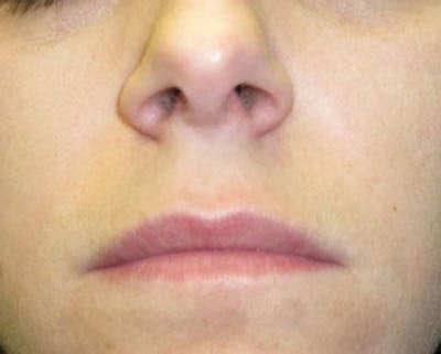 Injectables Before & After Gallery - Patient 174146570 - Image 1