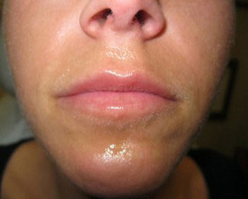 Injectables Before & After Gallery - Patient 174146570 - Image 2