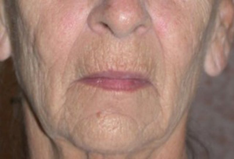 Injectables Before & After Gallery - Patient 174146574 - Image 1