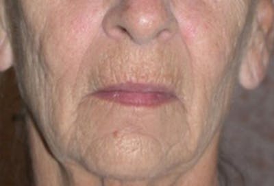 Injectables Before & After Gallery - Patient 174146574 - Image 1