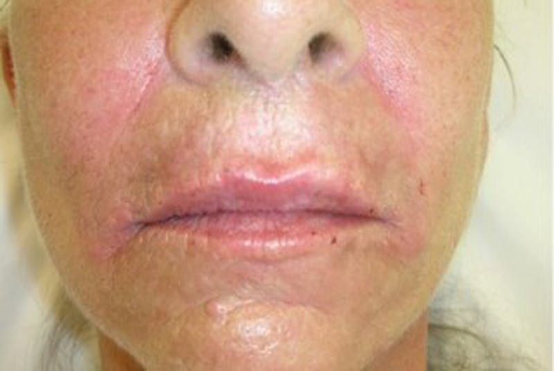 Injectables Before & After Gallery - Patient 174146574 - Image 2