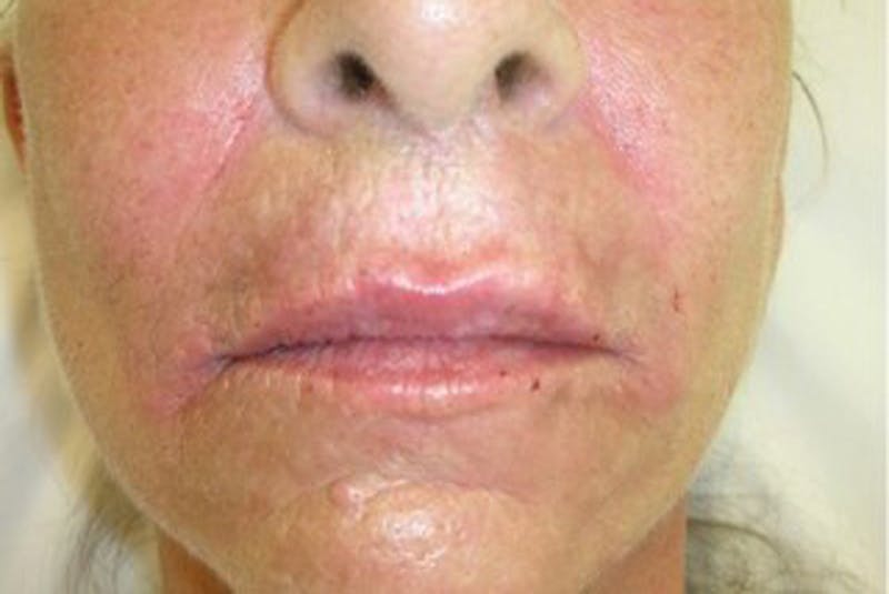 Injectables Before & After Gallery - Patient 174146574 - Image 2