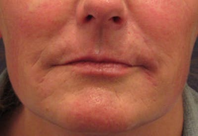 Injectables Before & After Gallery - Patient 174146577 - Image 1