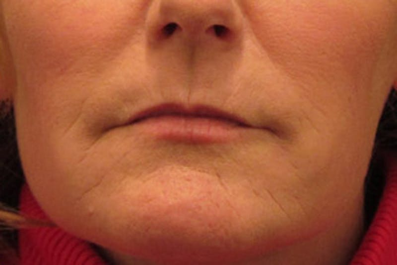Injectables Before & After Gallery - Patient 174146577 - Image 2