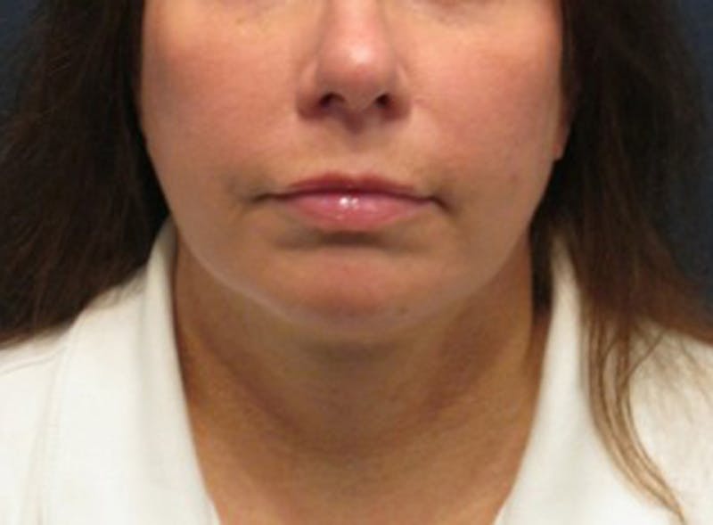 Injectables Before & After Gallery - Patient 174146582 - Image 2