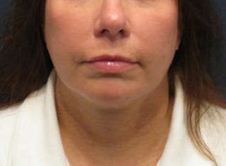 Injectables Before & After Gallery - Patient 174146582 - Image 2