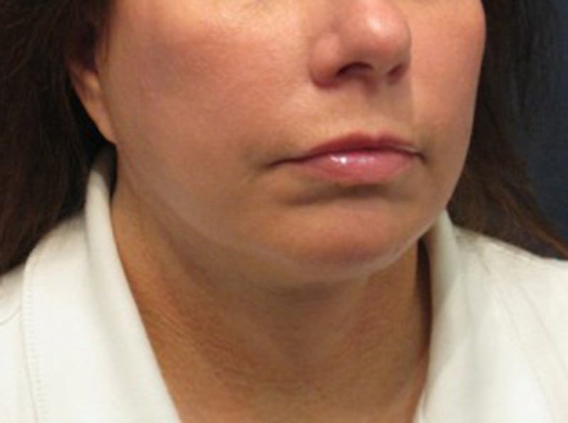 Injectables Before & After Gallery - Patient 174146582 - Image 4