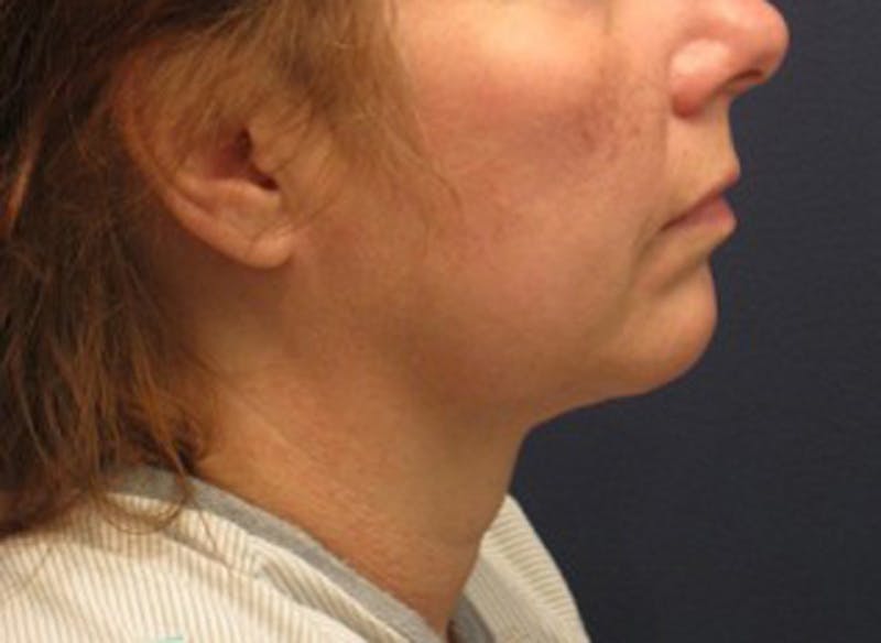 Injectables Before & After Gallery - Patient 174146582 - Image 5