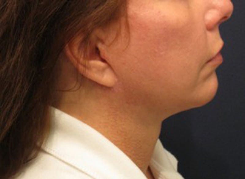 Injectables Before & After Gallery - Patient 174146582 - Image 6