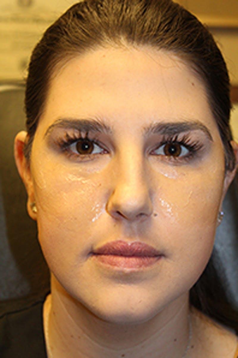 Injectables Before & After Gallery - Patient 174146587 - Image 1