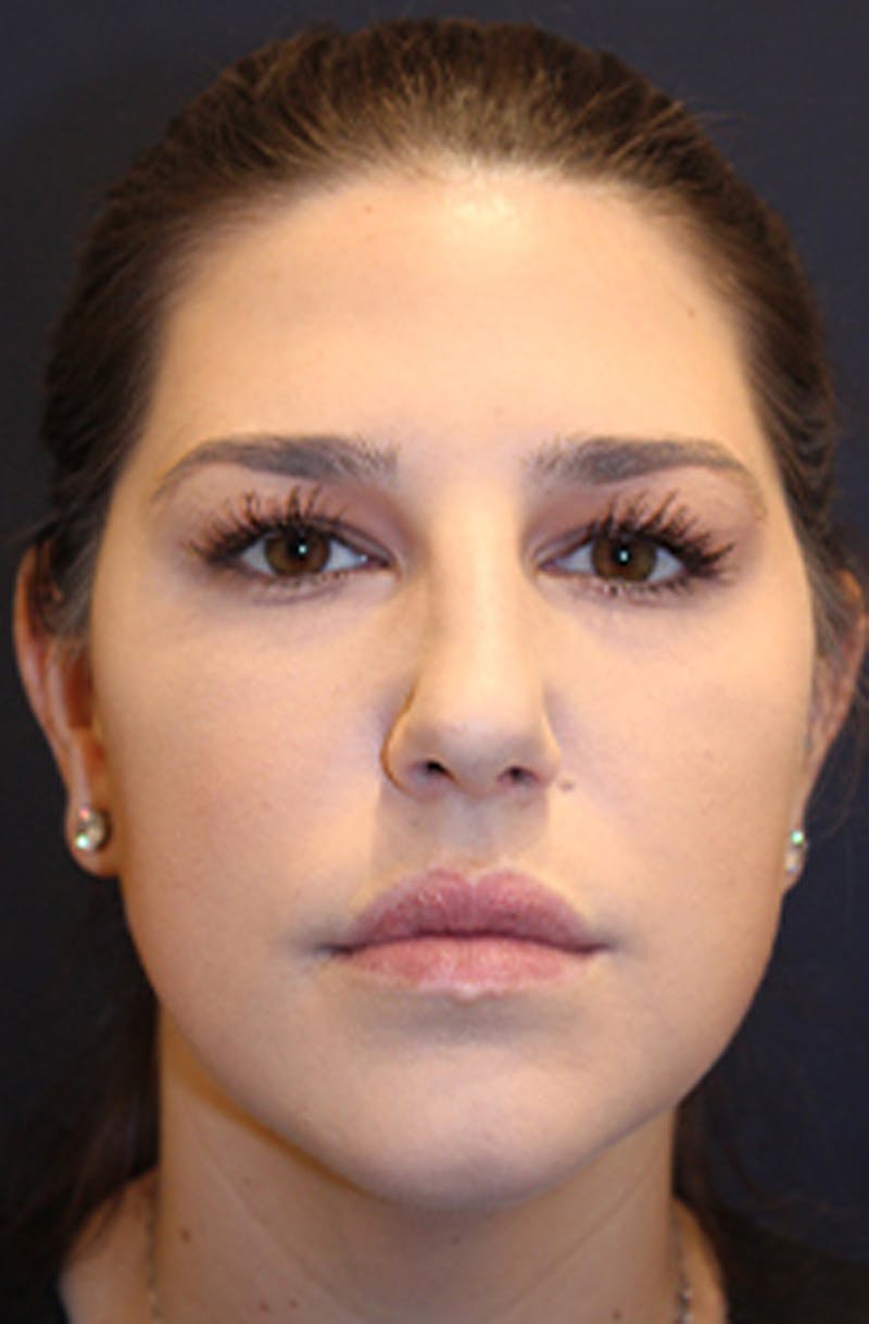 Injectables Before & After Gallery - Patient 174146587 - Image 2