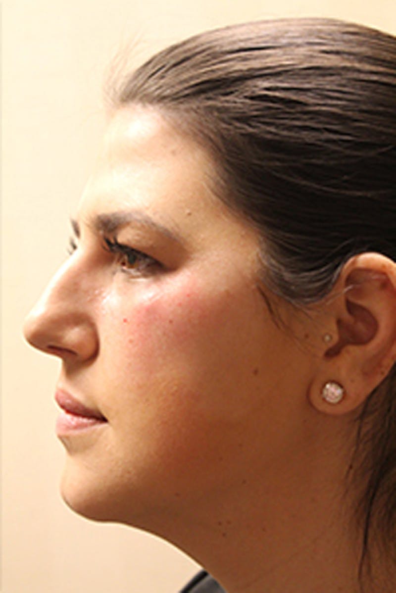 Injectables Before & After Gallery - Patient 174146587 - Image 3