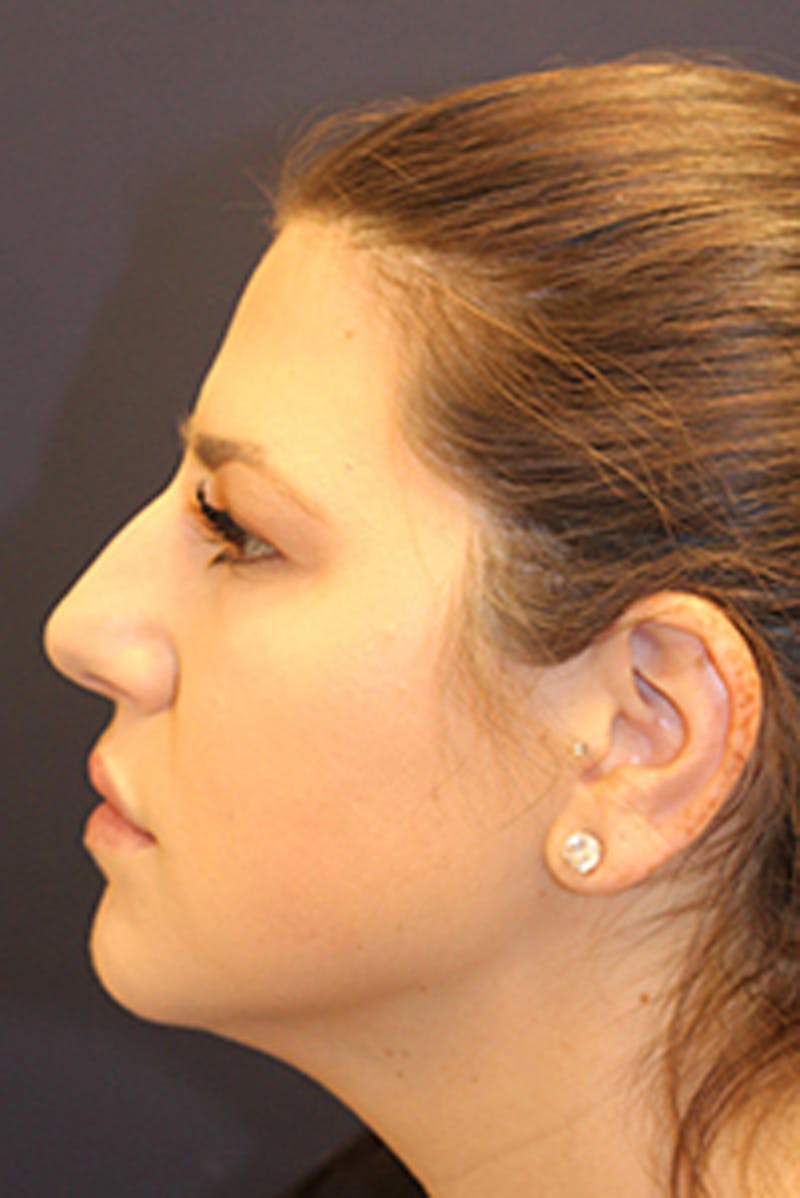Injectables Before & After Gallery - Patient 174146587 - Image 4