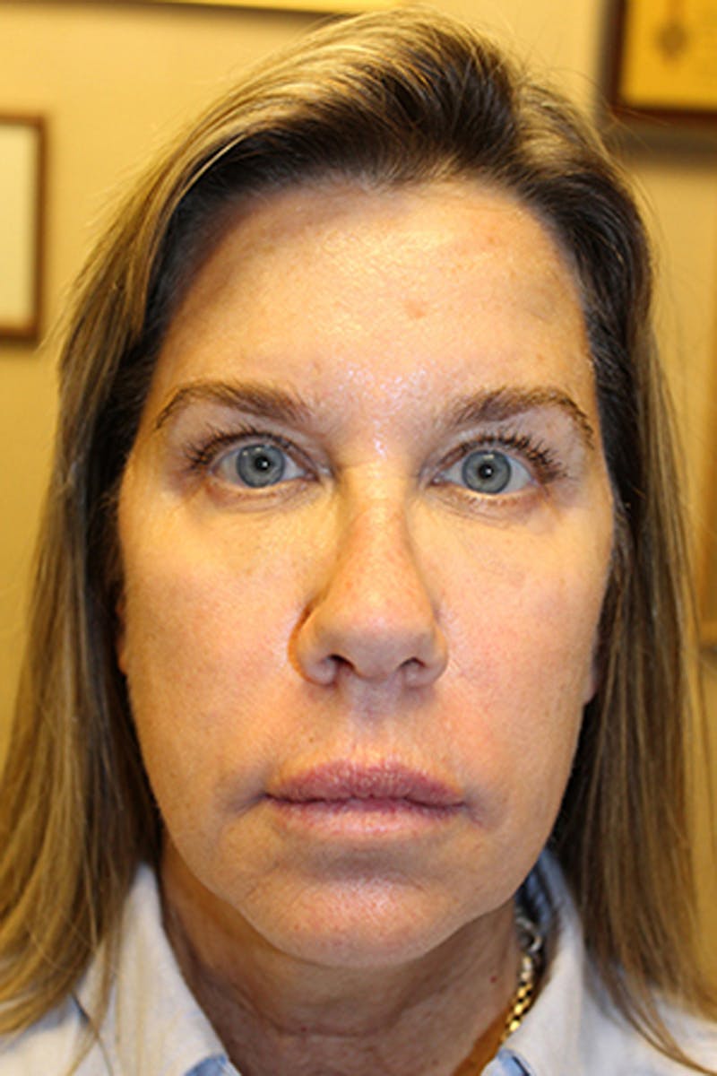 Injectables Before & After Gallery - Patient 174146593 - Image 1