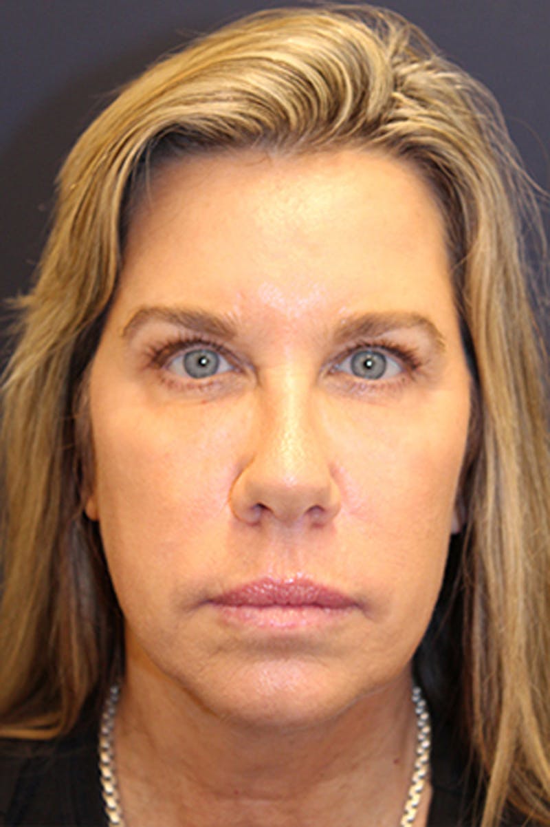 Injectables Before & After Gallery - Patient 174146593 - Image 2